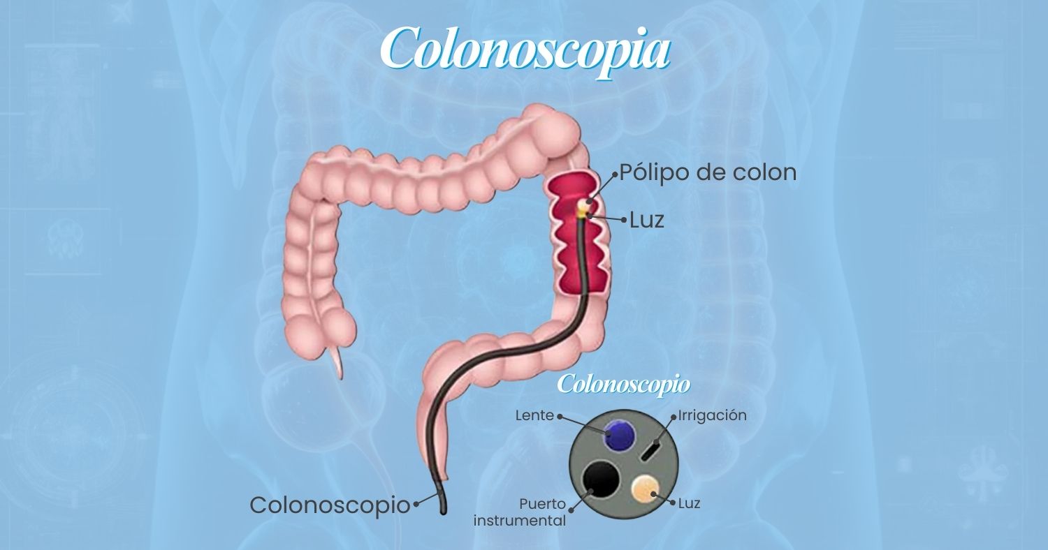 Colonoscopia preventiva en Tijuana: por qué se recomienda desde los 45 y qué esperar del estudio
